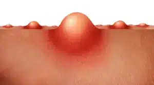 اسباب الحبوب في المناطق الحساسة للنساء